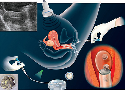 Embryo Transfer